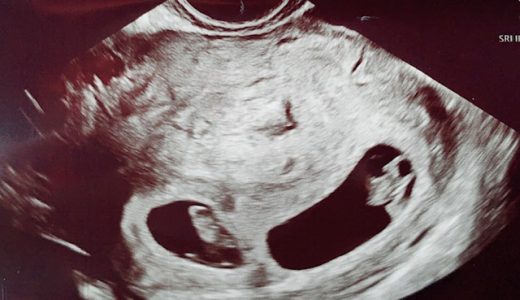 【7週】初回検診で双子妊娠が判明！心拍も二人分確認ができました
