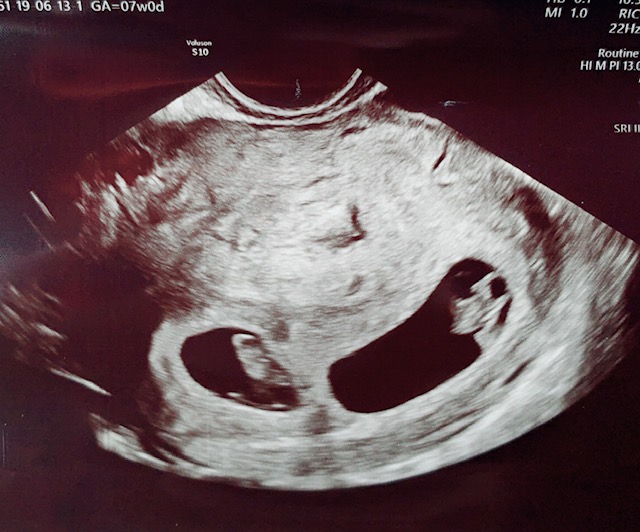 7週 初回検診で双子妊娠が判明 心拍も二人分確認ができました Taekoのocへいこう